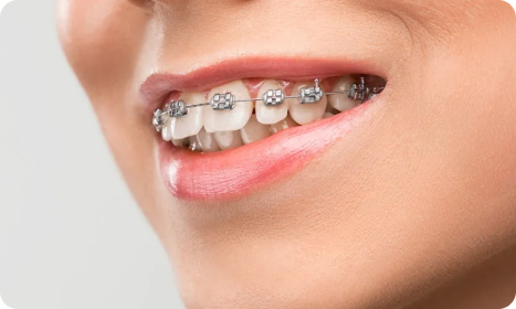 Braces Treatment