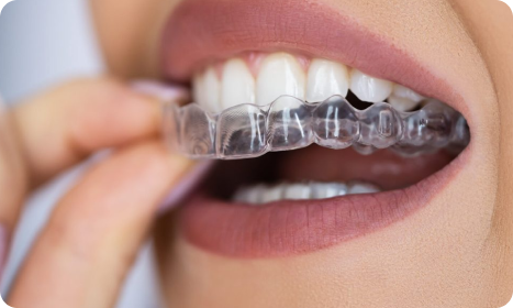 Clear Aligners