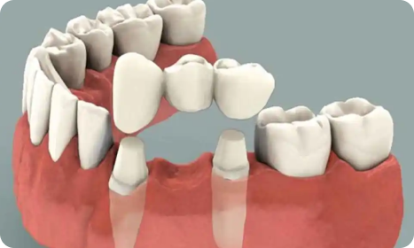 Dental Bridges