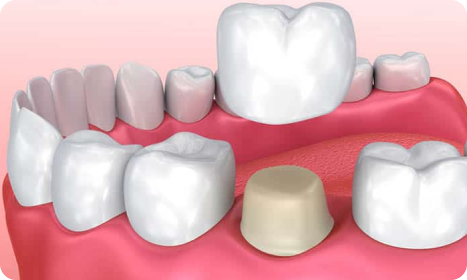 Dental Crowns