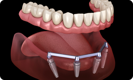 Full Mouth Dental Implants Advantage