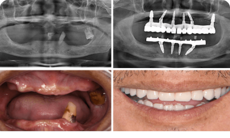 Full Mouth Dental Implants India