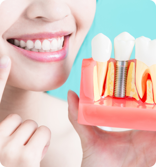 Dental Implants