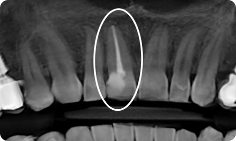 Painless Root Canal Benefits