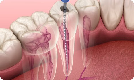 Painless Root Canal Treatment
