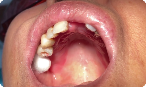 Painless Root Canal Trust