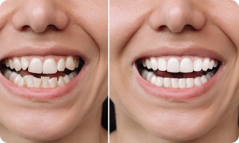 Smile with Aligners