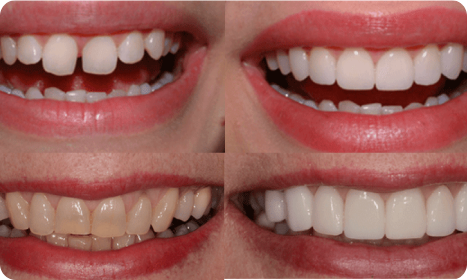 Veneers Benefits